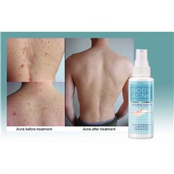 Спрей против Акне на теле очищающий Mistine, 50 мл. Таиланд