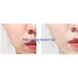 Маска Bafiger для отбеливания и удаления веснушек(87145)